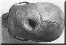 Trepanated Skull